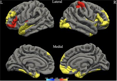 Investigating Gray and White Matter Structural Substrates of Sex Differences in the Narrative Abilities of Healthy Adults